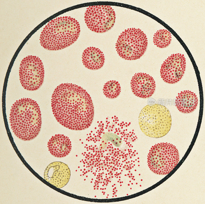 显微镜下观察嗜酸性粒细胞人类白细胞- 19世纪